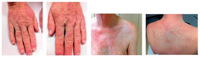 Abbildung 1 Rash unter Tripletherapie mit Telaprevir zu Woche 6. 
