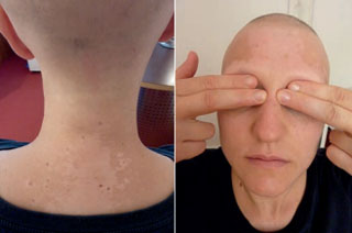 Abbildung 2a und b: Woche 32: Vier Wochen nach Therapieende. Vitiligo,  Effluvium und fehlende Augenbrauen.