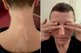Abbildung 3a und b: Fünf Monate, Therapieende. Deutlich gebesserter Befund im Gesicht. Vitiligo im Nacken unverändert.