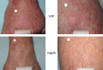 Abbildung 4: Hautreaktion bei einem Patienten 6 Wochen nach Beginn einer Tripletherapie mit Telaprevir.